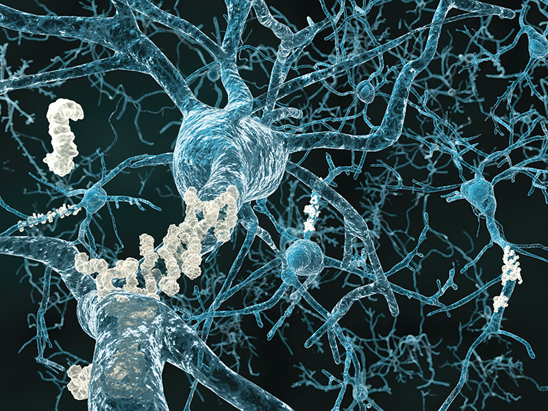 The brains of Alzheimers patients often reveal two phenomena: plaques and tangles. Here amyloid plaques attach to neurons within the brain.